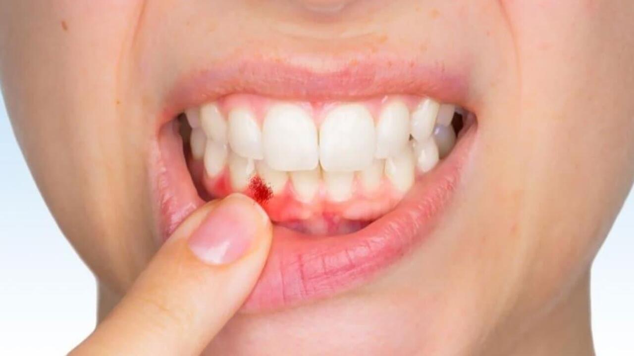 Diş kanaması durumunda oruç bozulur mu?